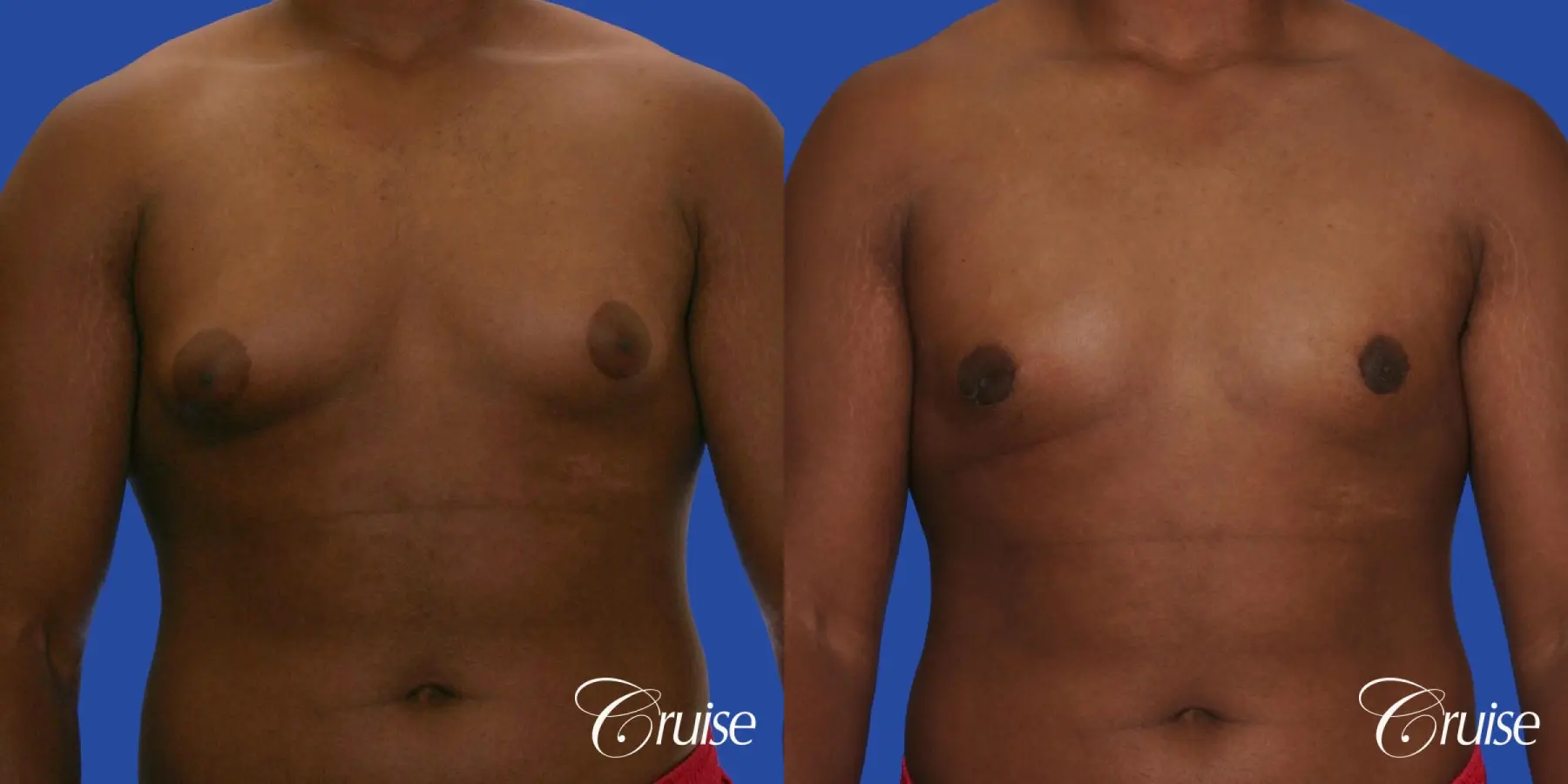 male breast moderate gynecomastia on young teen - Before and After 1