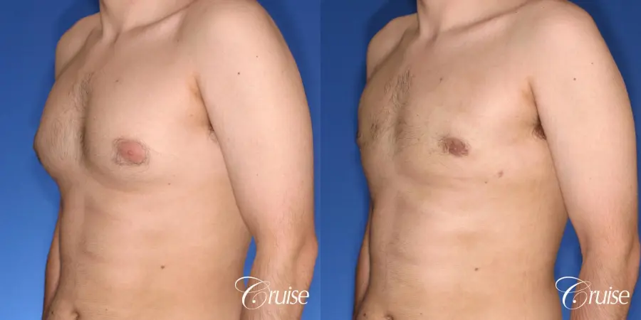 moderate gynecomastia puffy nipple - Before and After 3