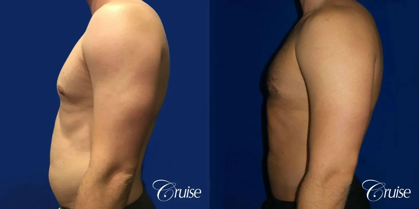 Type 2/3 Asymmetric Gynecomastia  - Before and After 3
