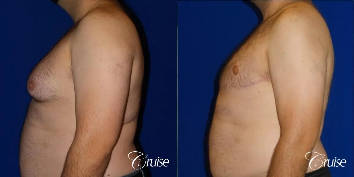 severe gynecomastia surgery - Before and After 3