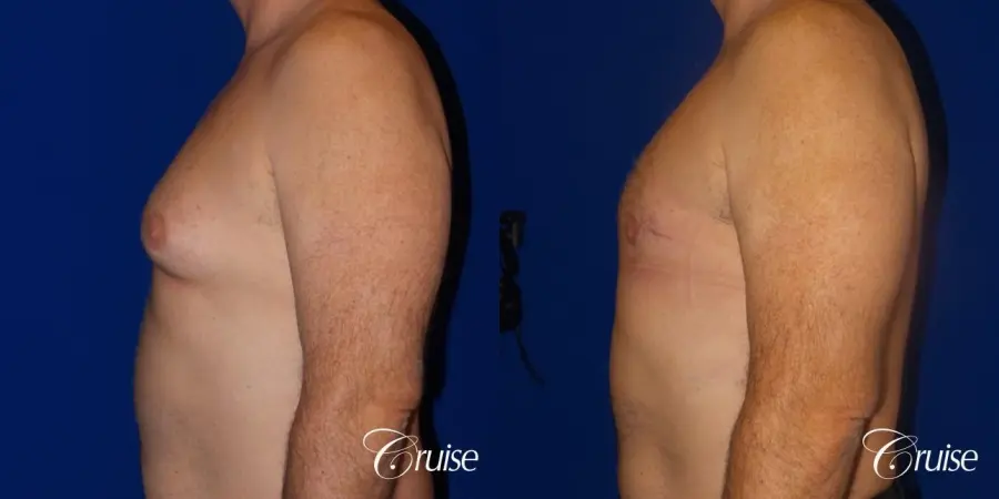 gynecomastia surgery results - Before and After 3