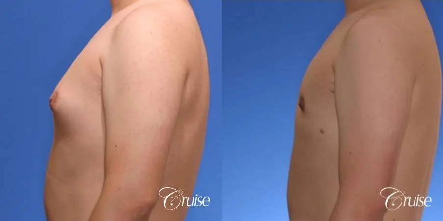 young male with mild gynecomastia surgery for puffy nipple - Before and After 2