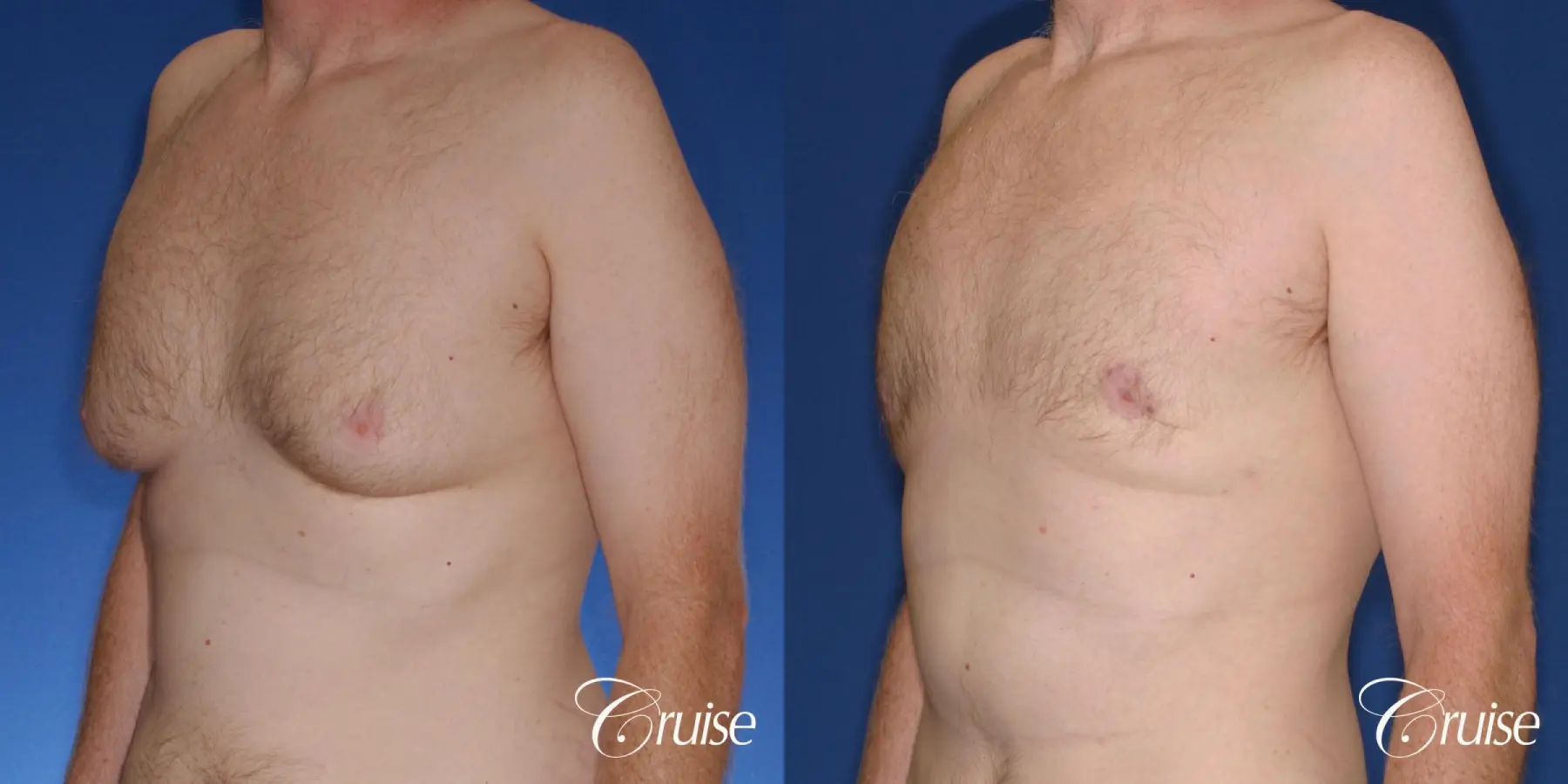 best donut lift with gynecomastia surgery - Before and After 2