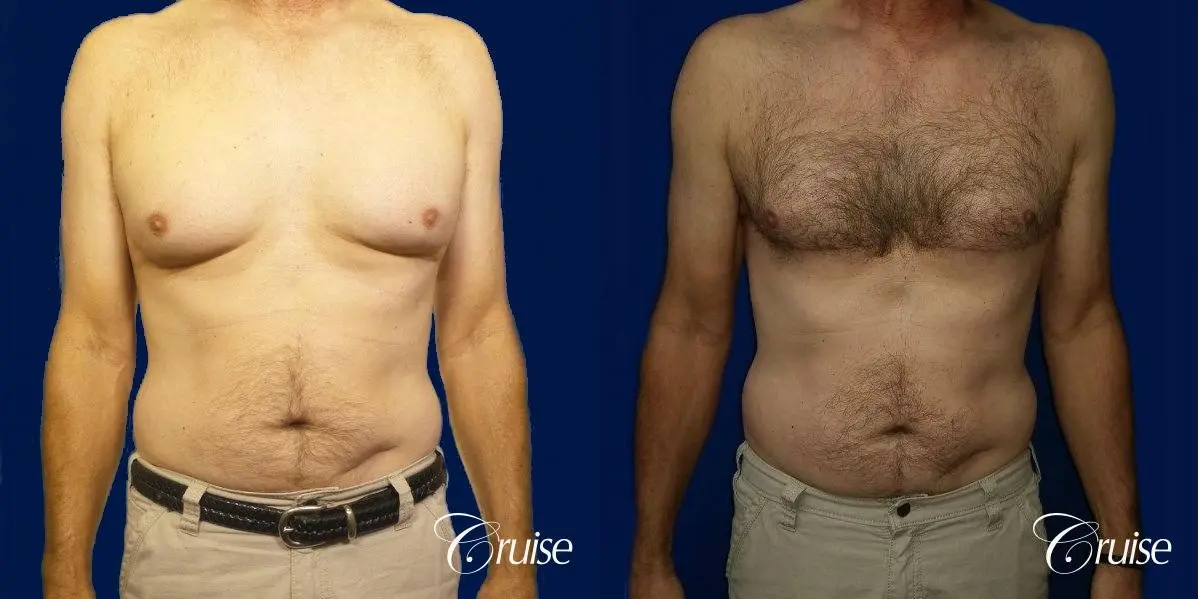 Type 4 Gynecomastia Gland Removal & Liposuction  - Before and After 1