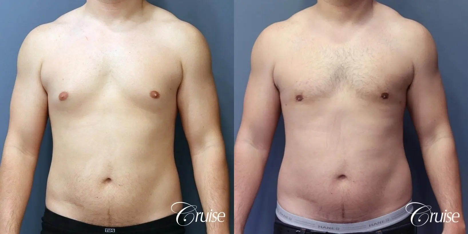 Gynecomastia: Patient 147 - Before and After 1