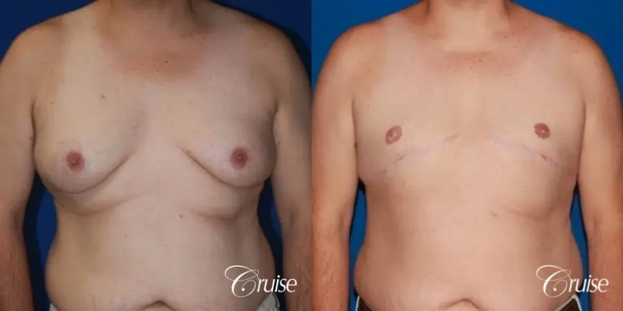 male breast severe gynecomastia free nipple graft anchor - Before and After 1
