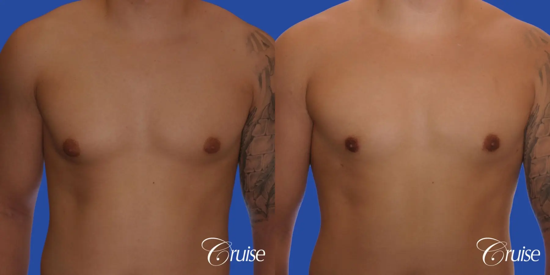 mild gynecomastia with puffy nipple and areola incision - Before and After 1