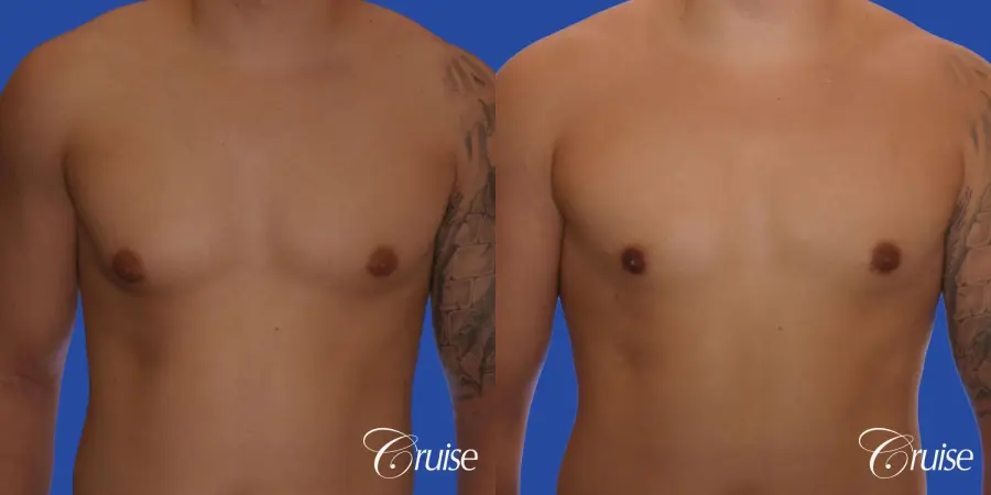 mild gynecomastia with puffy nipple and areola incision - Before and After 1