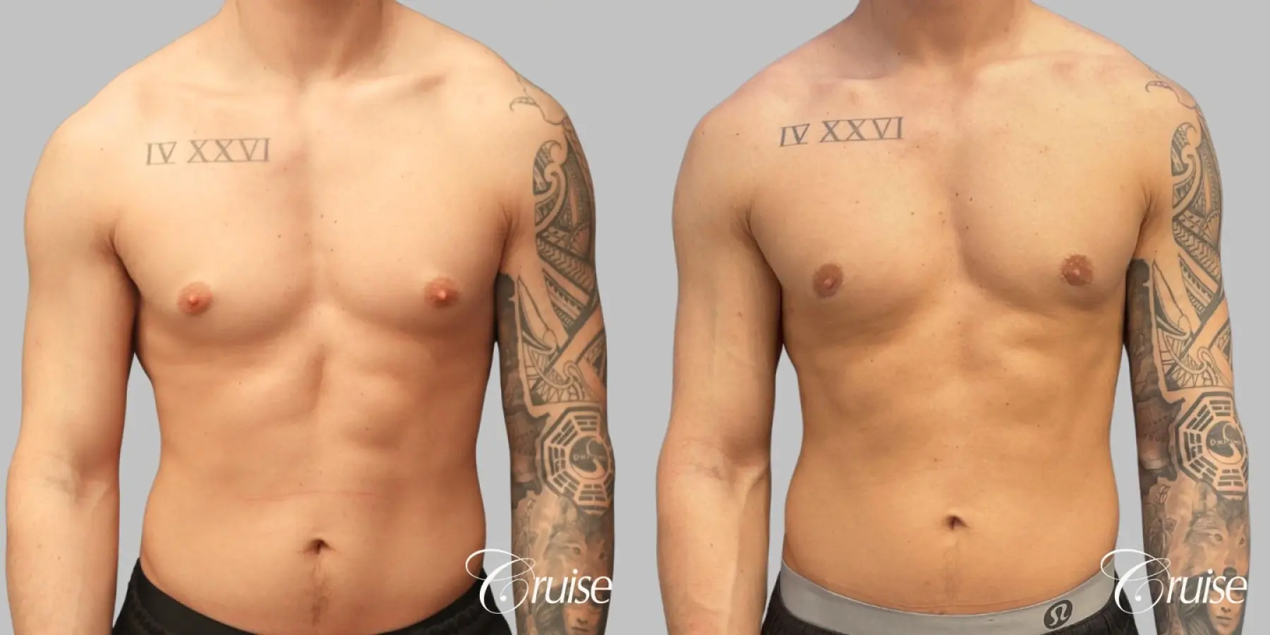 Gynecomastia Type 1 Inferior Crescent - Before and After 1