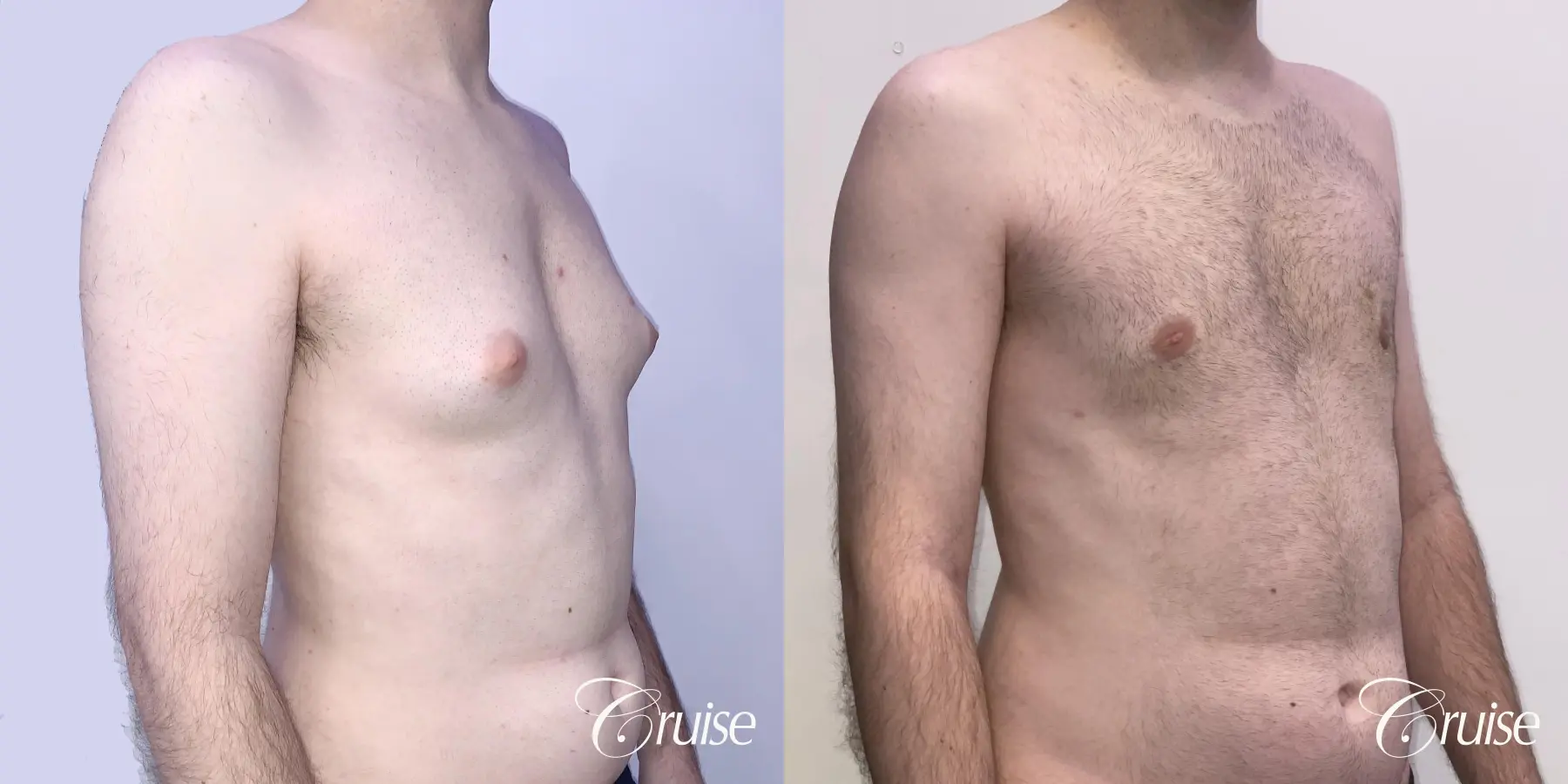 Gynecomastia: Patient 132 - Before and After 5