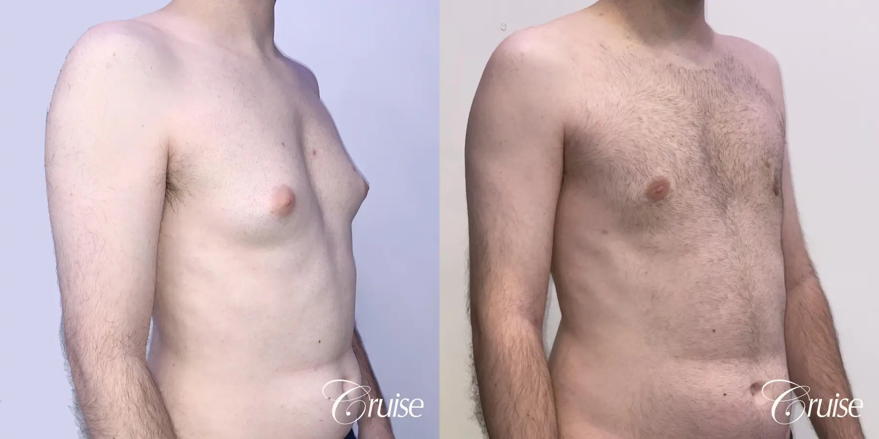 Gynecomastia: Patient 134 - Before and After 5