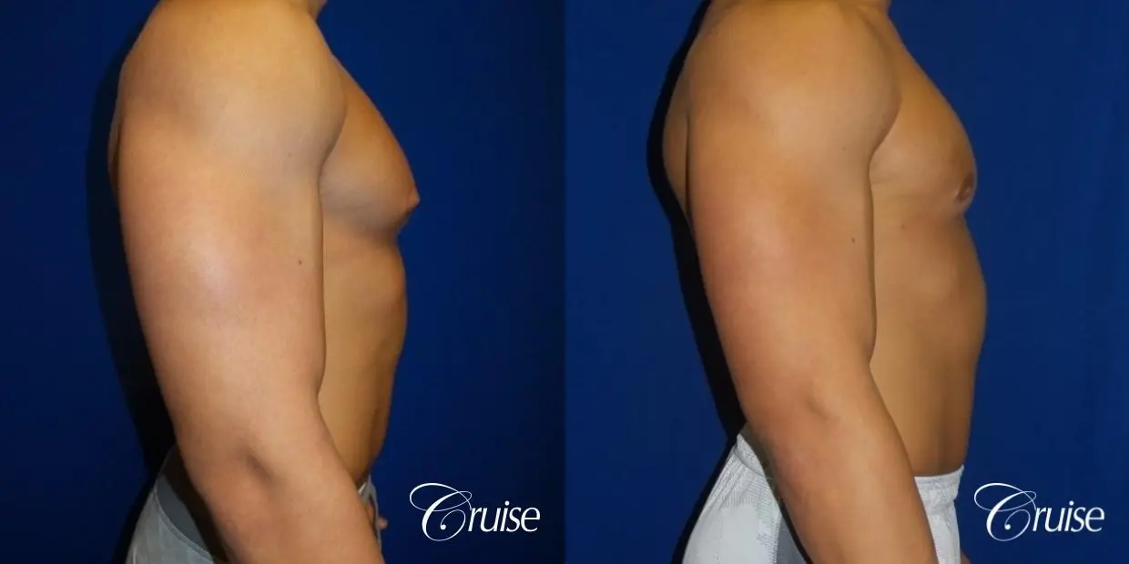 bodybuilder with gynecomastia - Before and After 2