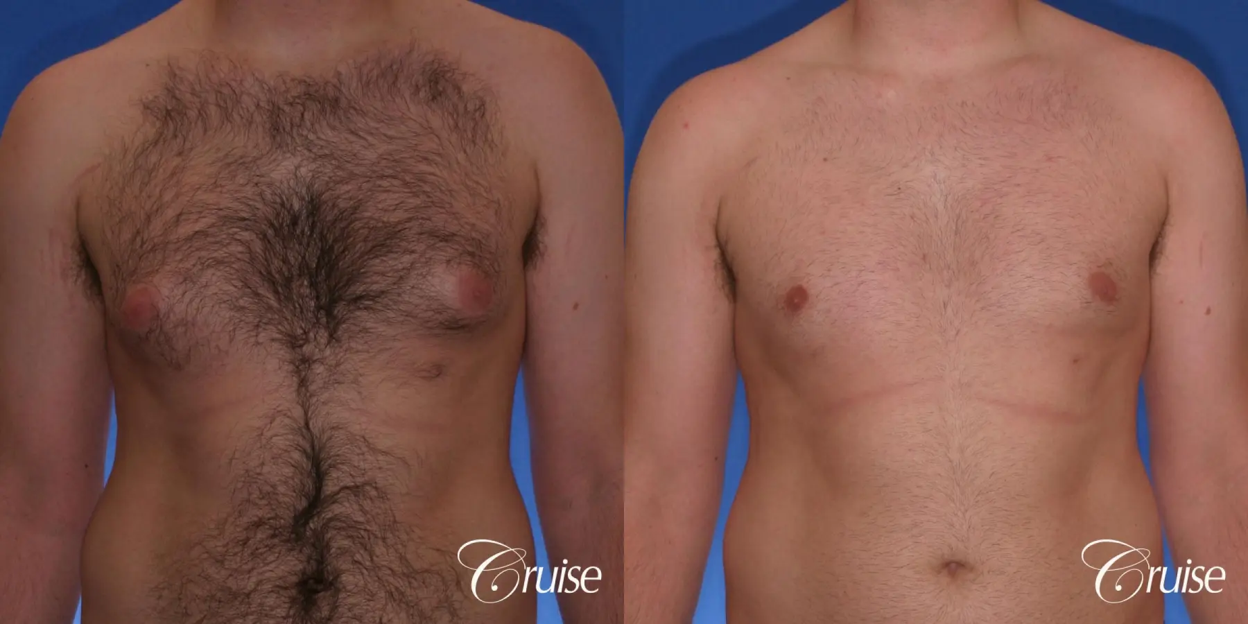 best Puffy nipple correction and gynecomastia on young adult - Before and After 1