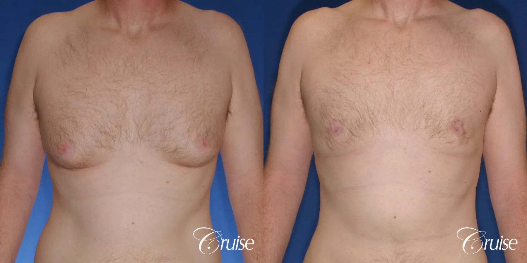 best donut lift with gynecomastia surgery - Before and After 1