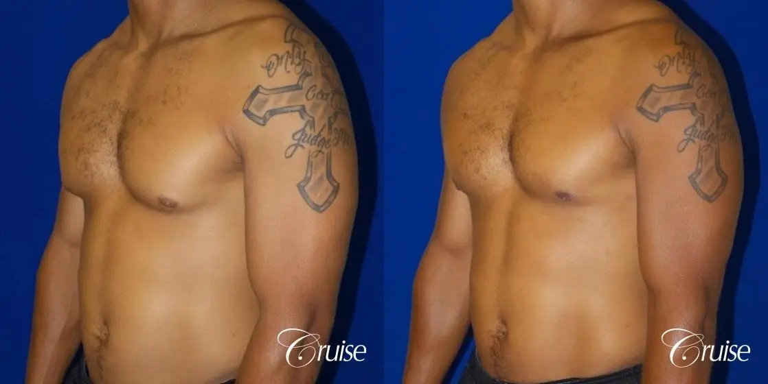 gynecomastia caused by testosterone - Before and After 3