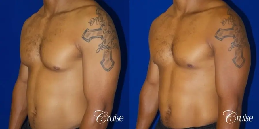 gynecomastia caused by testosterone - Before and After 3