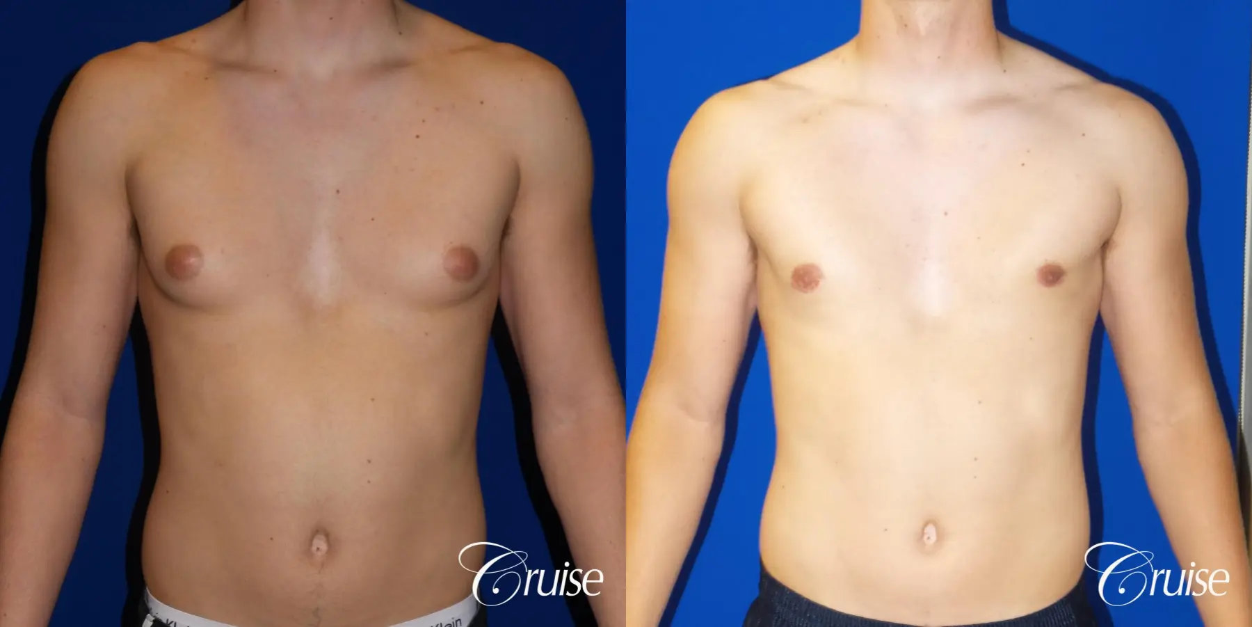 Best moderate gynecomastia on male adult - Before and After 1