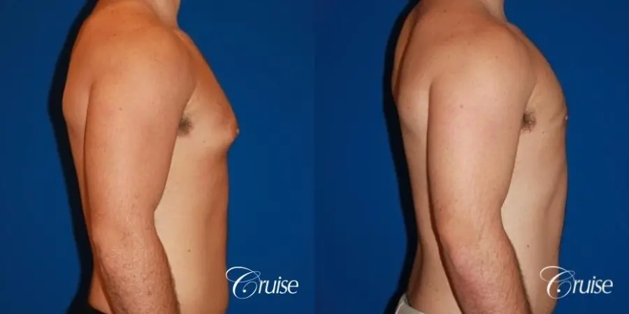 athletic adult with puffy nipple - Before and After 4