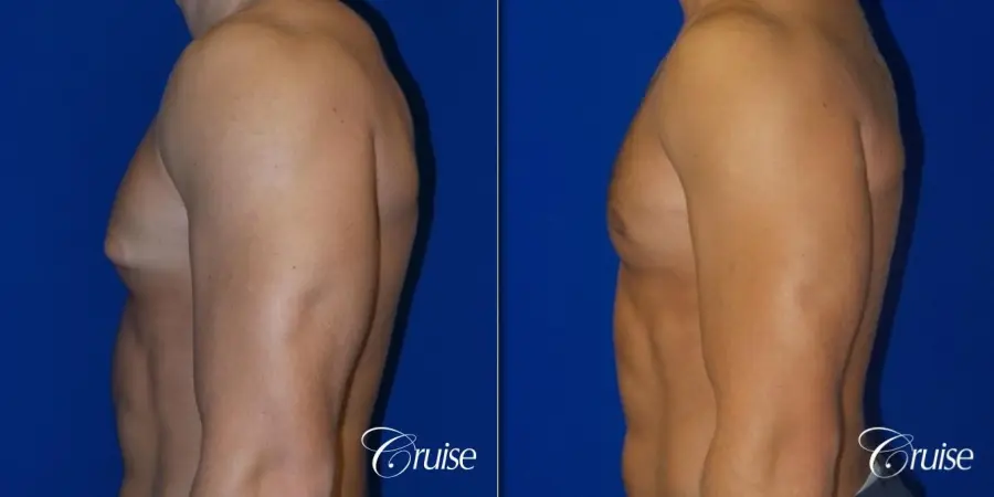 male breast reduction surgery newport beach - Before and After 3