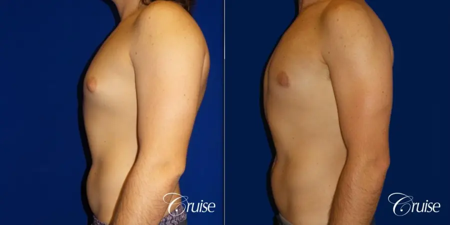 Type 2 Gynecomastia Glandular Removal  - Before and After 3