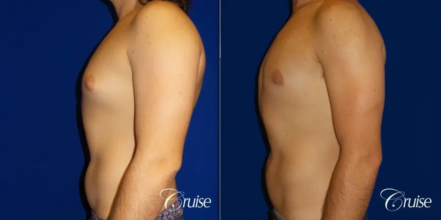 Type 2 Gynecomastia Glandular Removal - Before and After 3