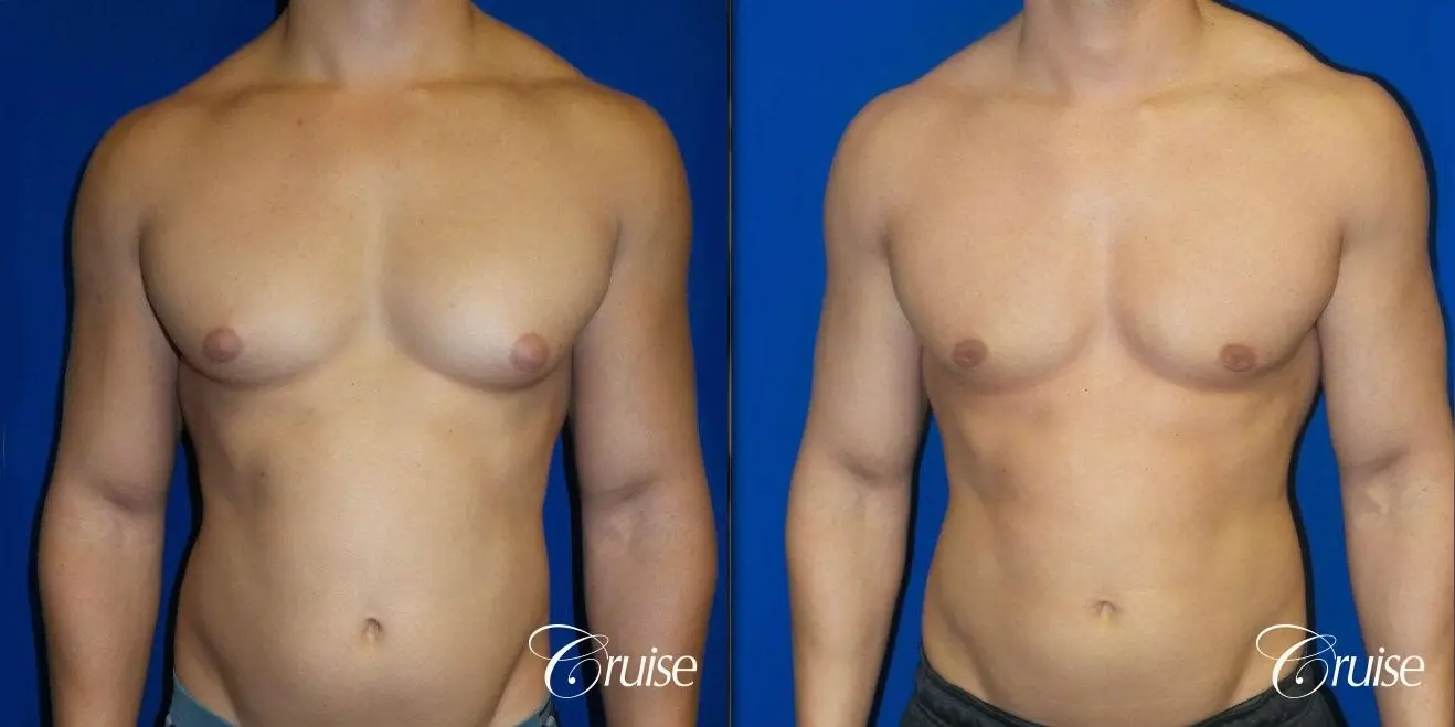 Best before and after gynecomastia pictures - Before and After 1