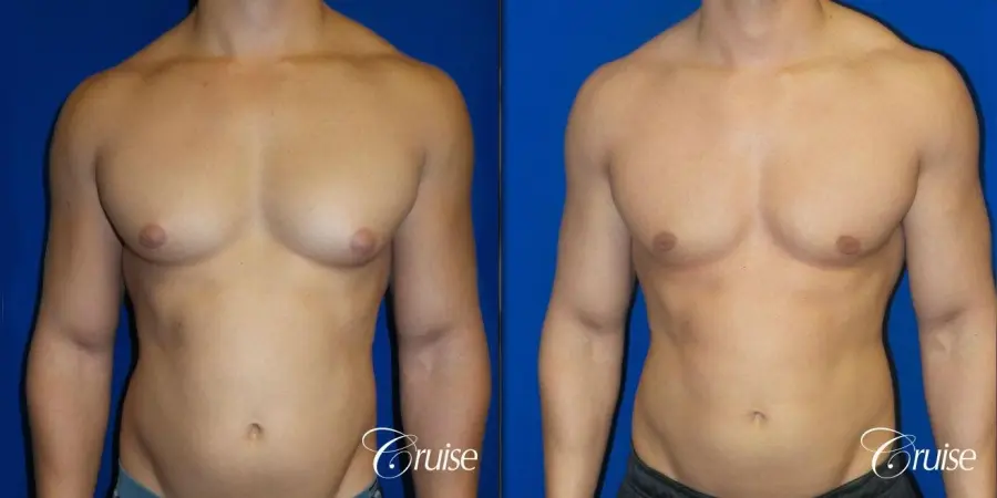 Best before and after gynecomastia pictures - Before and After 1