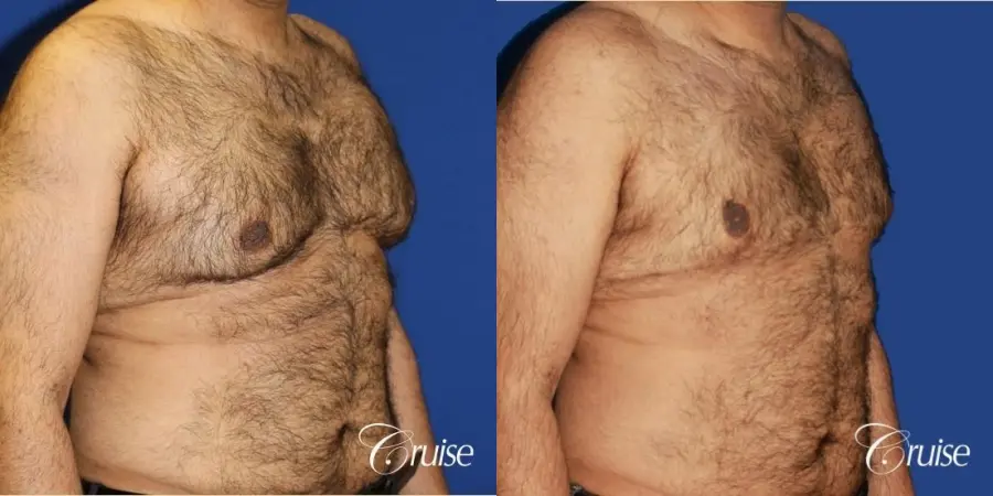 40 year old with severe gynecomastia results - Before and After 2