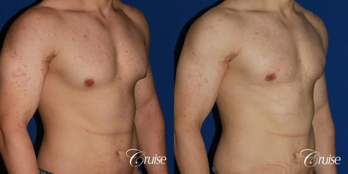 mild-gynecomastia-revision - Before and After 3