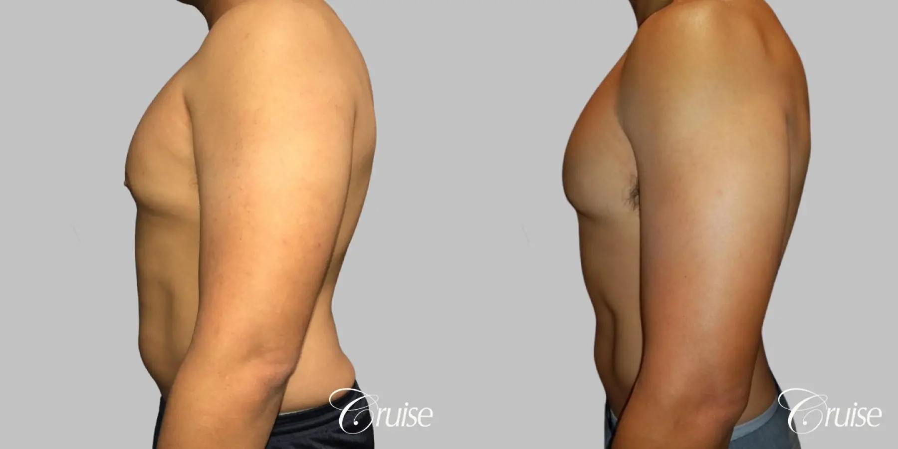 Type 2 Gynecomastia with Areola Incision - Before and After 3