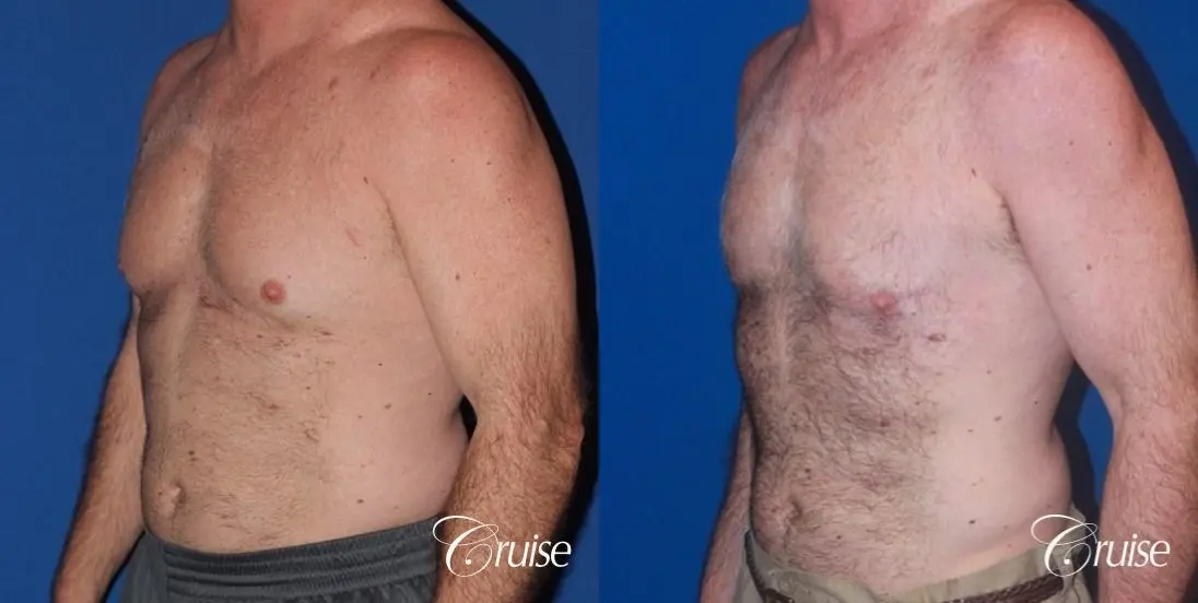 extended pa incision on gynecomastia patient - Before and After 2