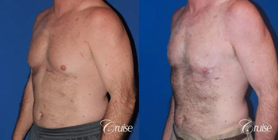 extended pa incision on gynecomastia patient - Before and After 2