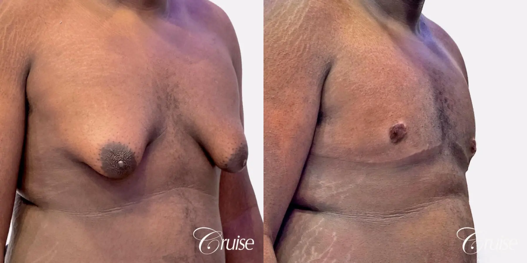 Gynecomastia Type 4 - Before and After 3