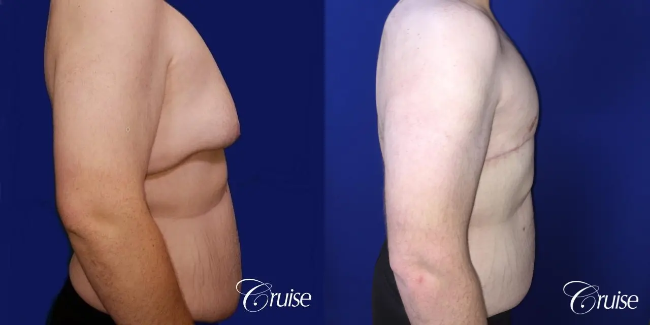severe gynecomastia - Before and After 2