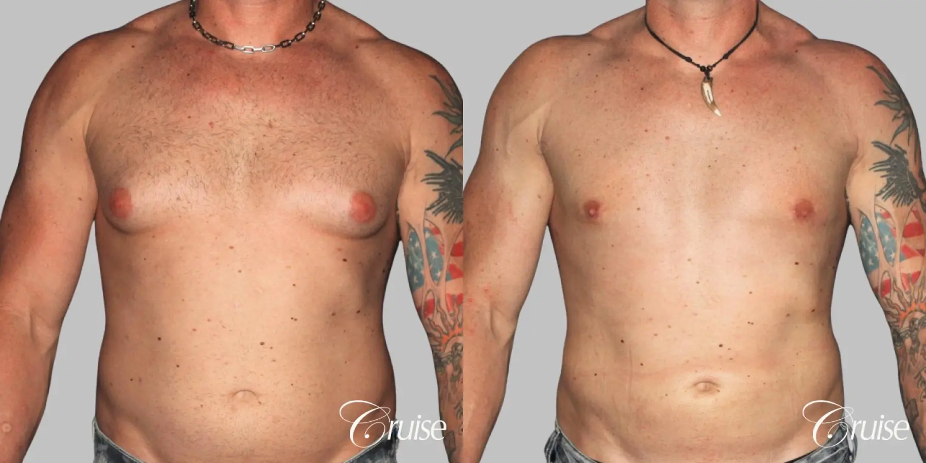 Athletic adult gynecomastia with glandular tissue removal - Before and After