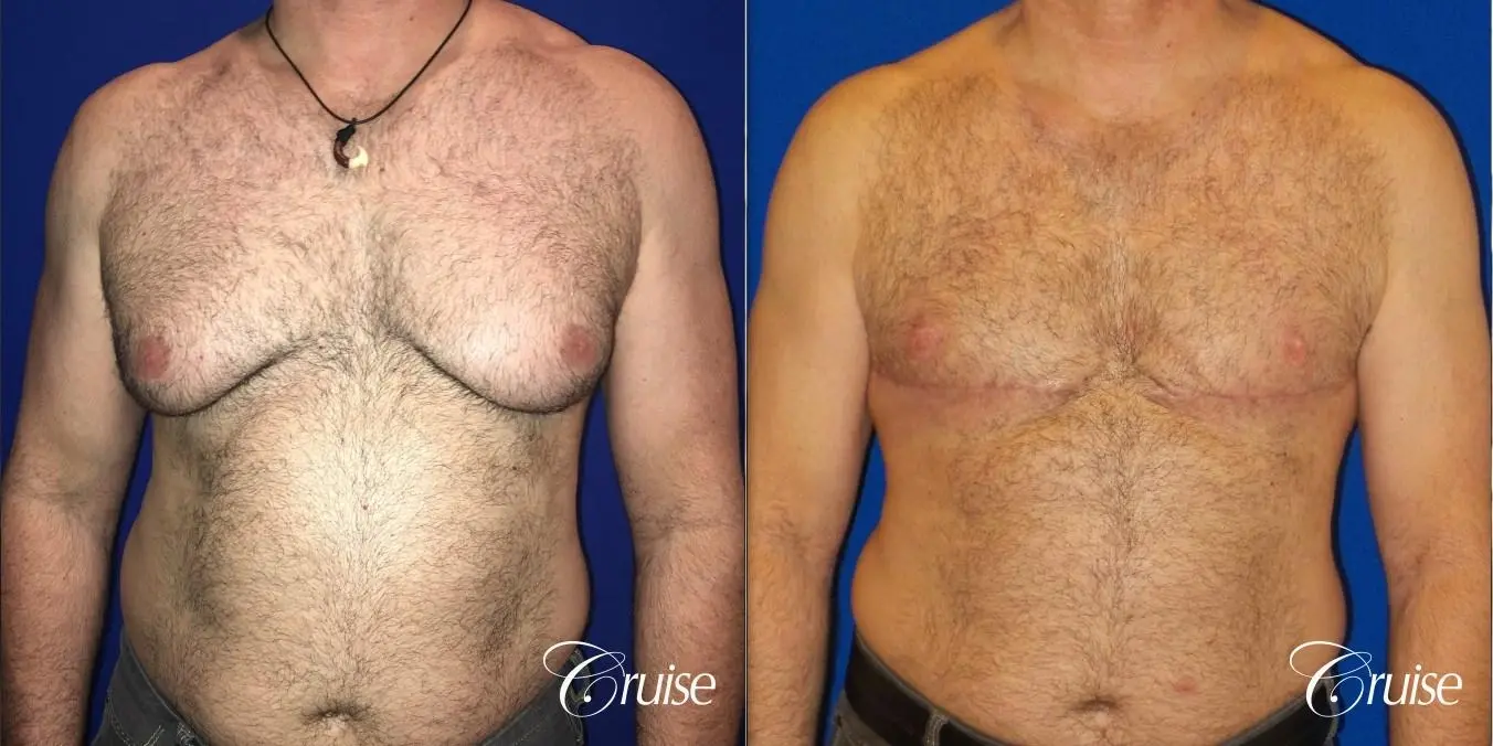 Severe Gynecomastia Correction - Before and After 1