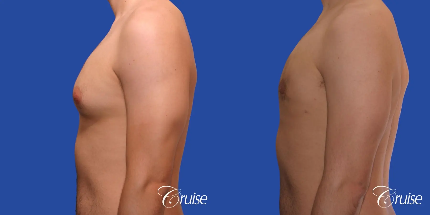 Type 2 Gynecomastia Young Adult - Before and After 2
