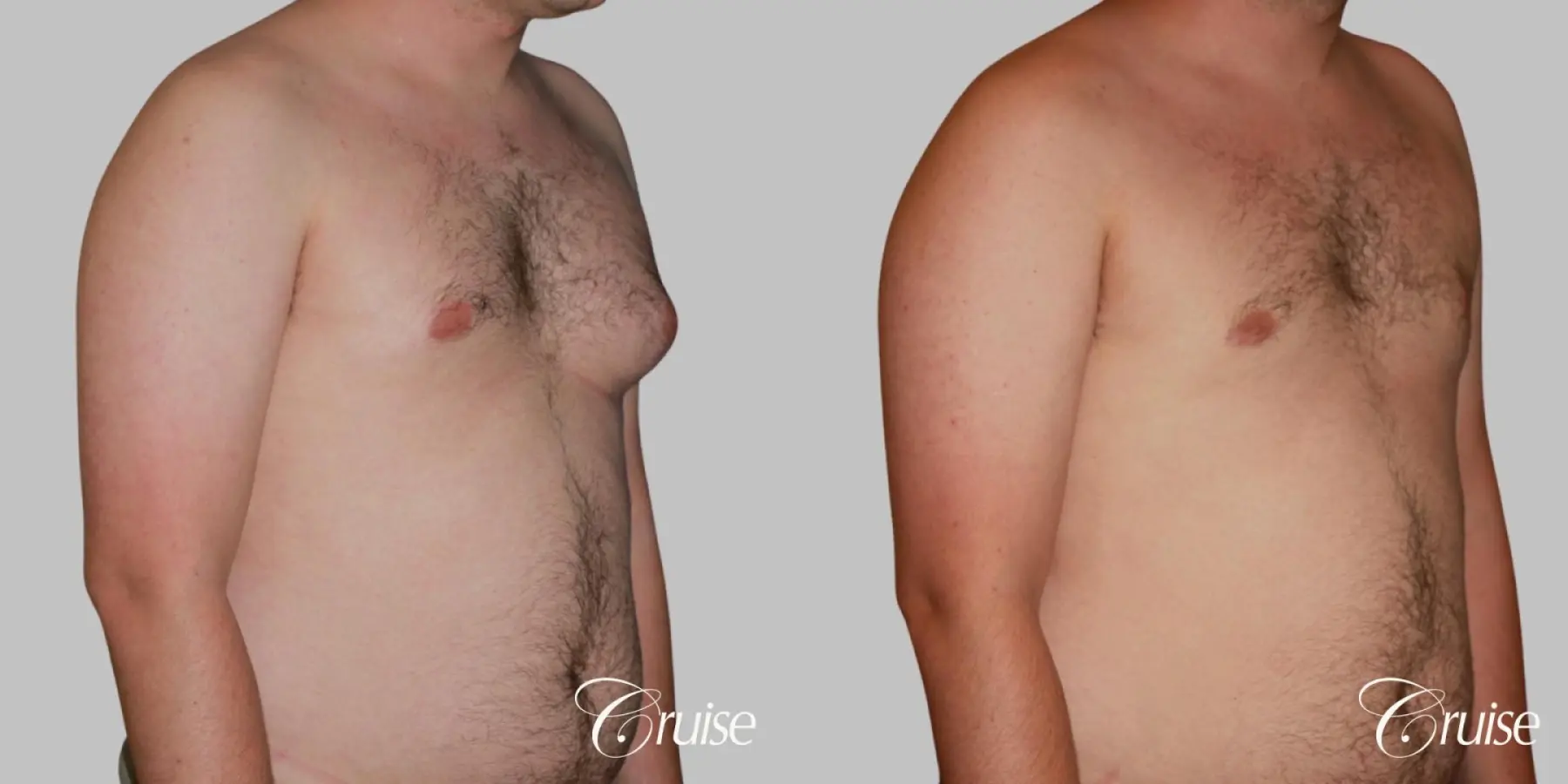 asymmetric gynecomastia moderate - Before and After 2