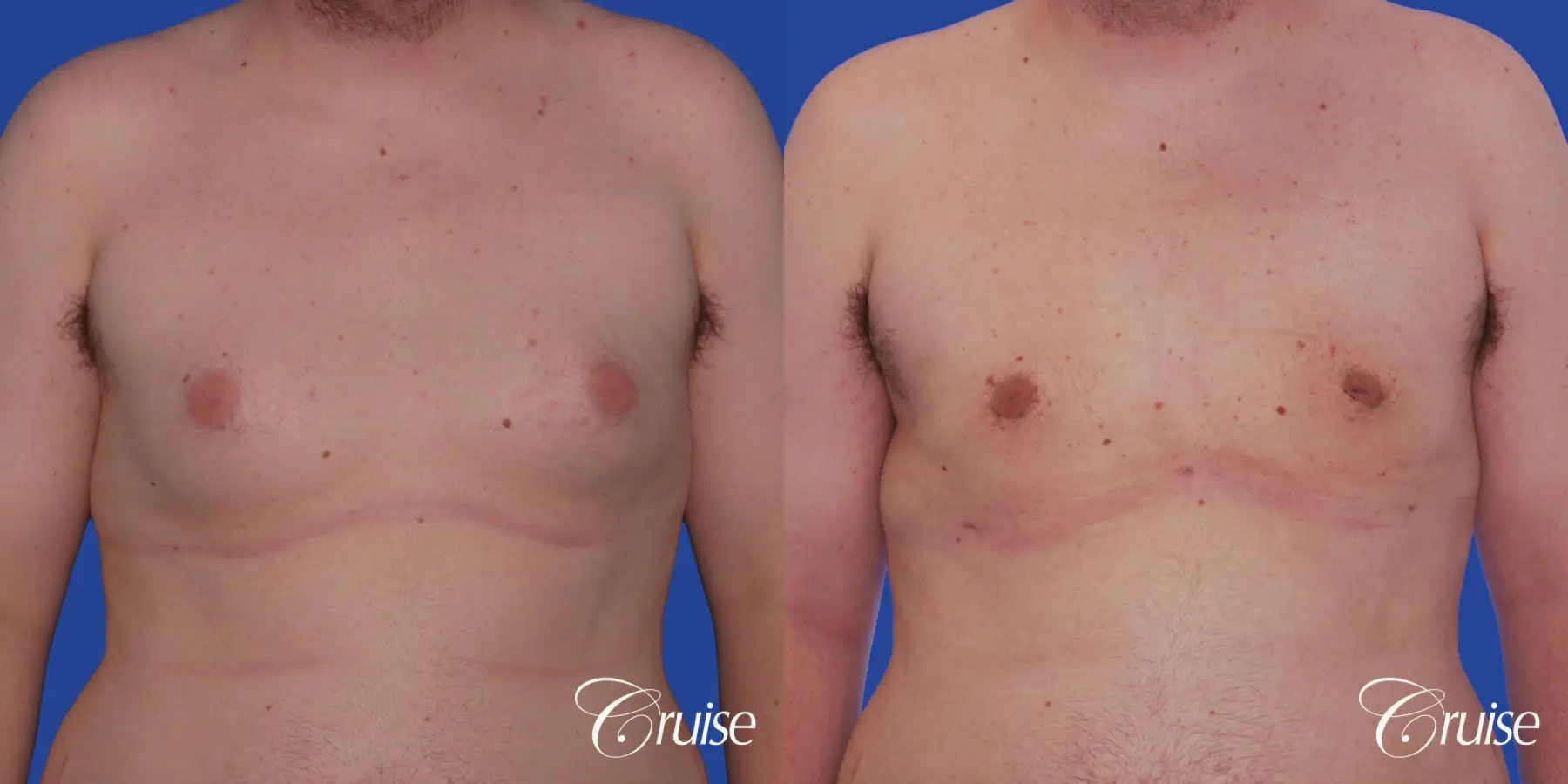 Type 2 Gynecomastia with Excess Breast Tissue - Before and After 1