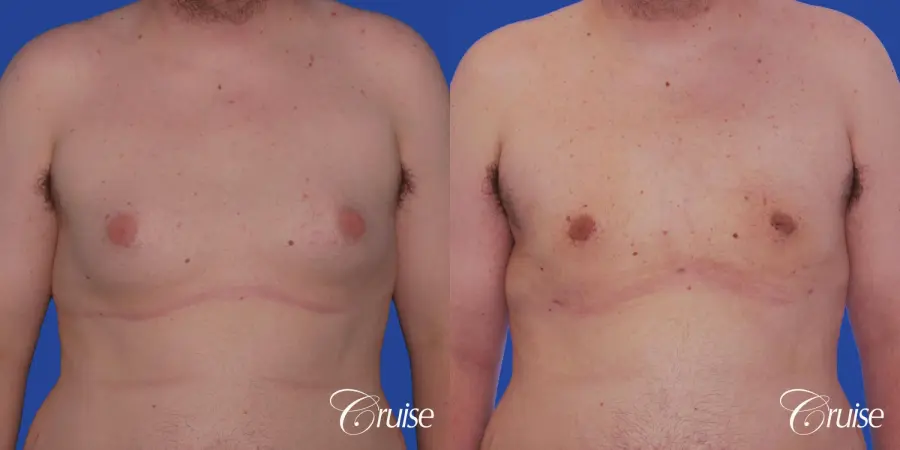 Type 2 Gynecomastia with Excess Breast Tissue - Before and After 1