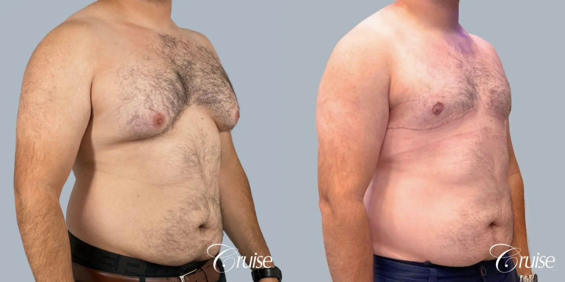 Gynecomastia: Patient 9 - Before and After 2