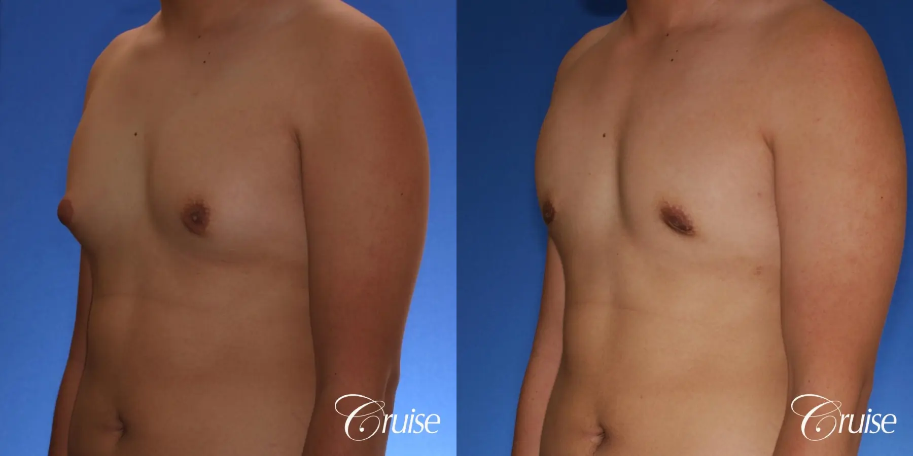 best gynecomastia surgery with plastic surgeon, Dr. Cruise - Before and After 3