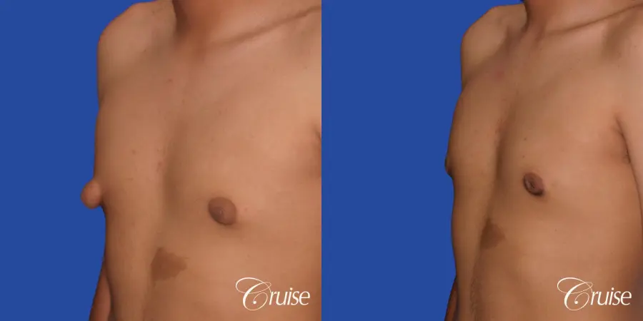 gynecomastia patient gets nipple reduction for best results - Before and After 3