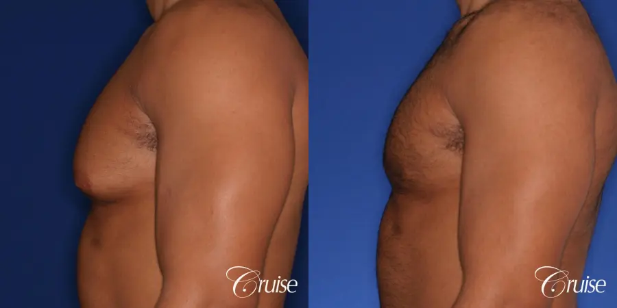 26 yo athletic patient with moderate gynecomastia - Before and After 2