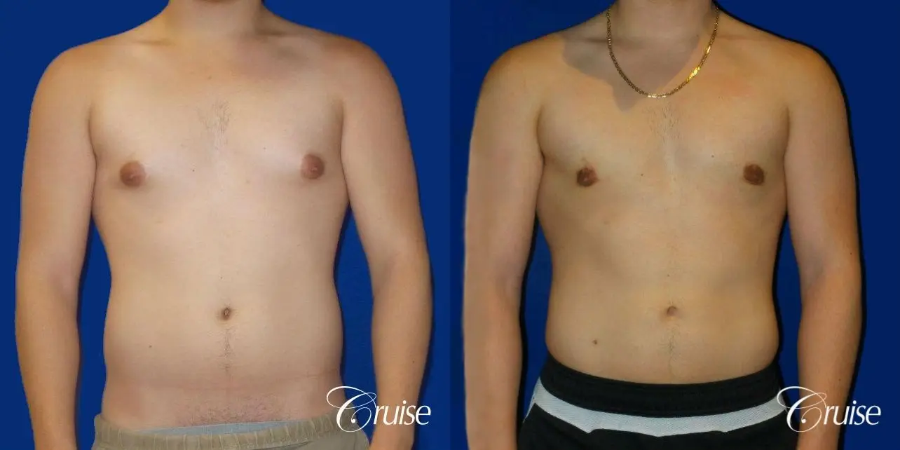 Best Gynecomastia surgeons Southern California - Before and After 1