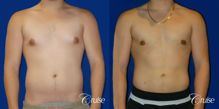 Best Gynecomastia surgeons Southern California - Before and After 1