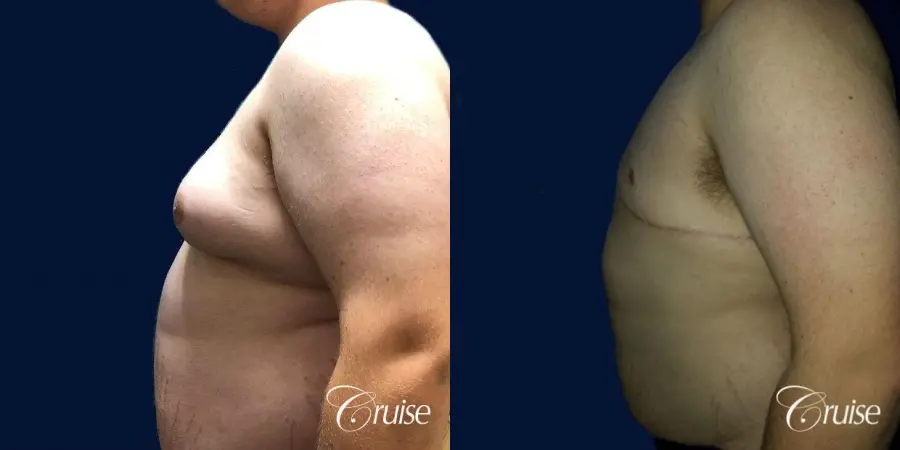 male breast reduction surgery orange county - Before and After 2