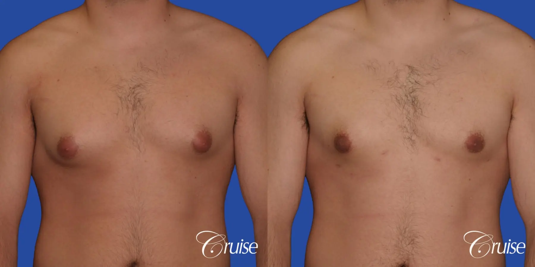 mild case of gynecomastia on adult - Before and After 1