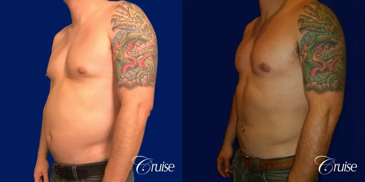 gynecomastia with skin laxity - Before and After 3