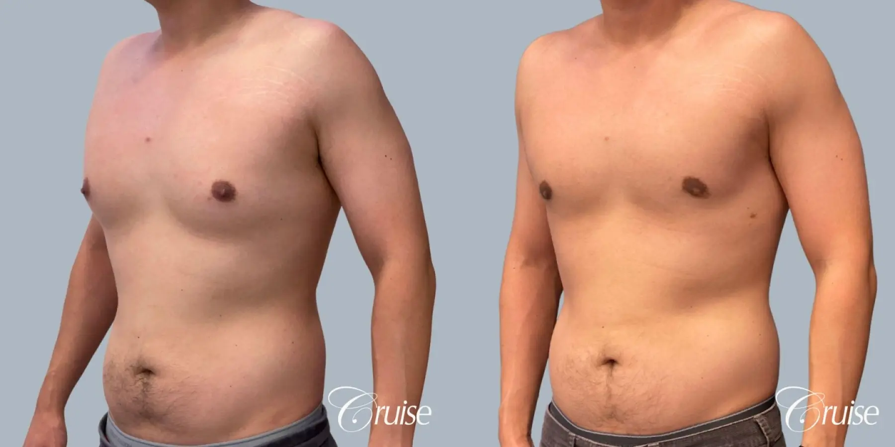 Gynecomastia: Patient 154 - Before and After 3